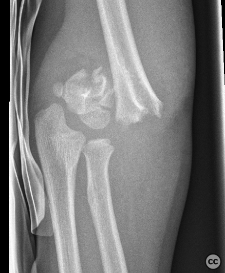 Gartland III-IV SCH fracture - closed reduction and k-wire fixation